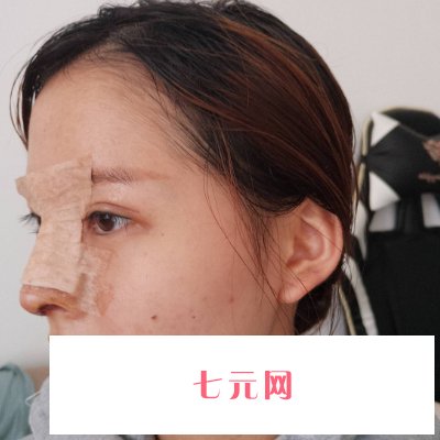 郑州集美陈曦做鼻子怎么样？医生招牌实例曝光