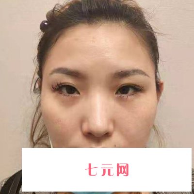 南京华美王小林割双眼皮成果好吗?新版实例公开