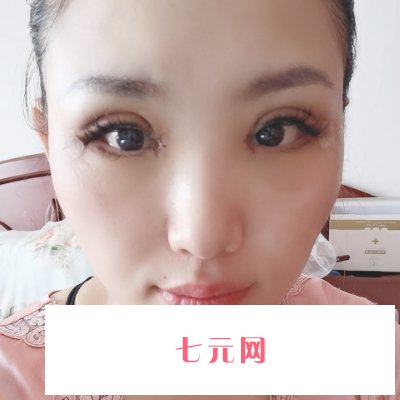 南京华美王小林割双眼皮成果好吗?新版实例公开