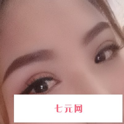 南京华美王小林割双眼皮成果好吗?新版实例公开