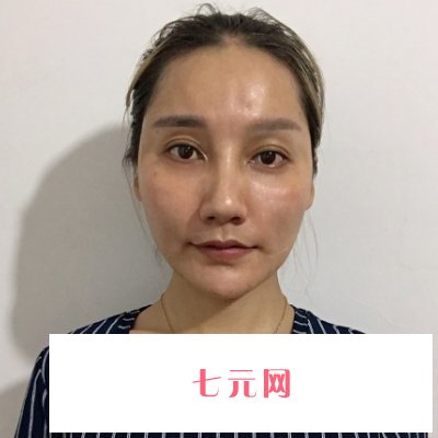 无锡同舟医疗美容医院注射除皱实例发布|成果自然无痕