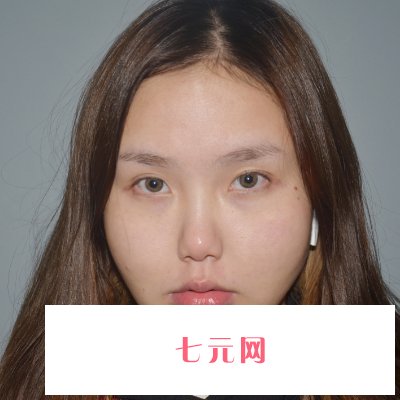 成都赵延峰医生面部吸脂实例展示|前后对比成果让人惊讶