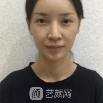 杭州时光吕敏隆鼻实例，鼻子形状没关，看上去就是气质美女