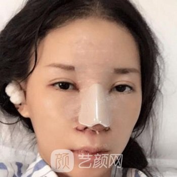 杭州时光吕敏隆鼻实例，鼻子形状没关，看上去就是气质美女