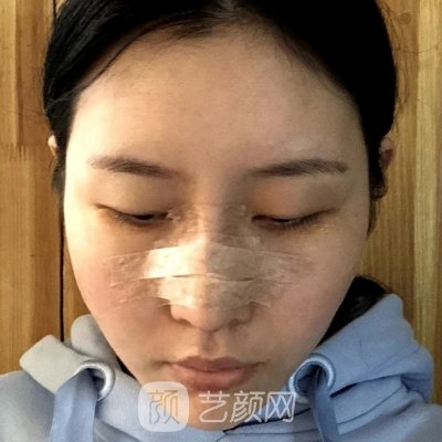 北京李劲良做鼻子口碑好吗?医生实力及实例曝光