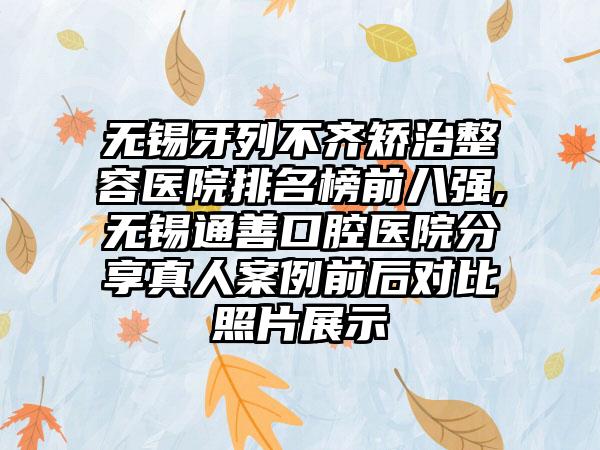 无锡牙列不齐矫治整容医院排名榜前八强,无锡通善口腔医院分享真人实例前后对比照片展示