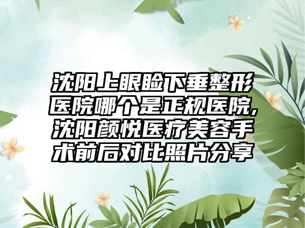 沈阳上眼睑下垂整形医院哪个是正规医院,沈阳颜悦医疗美容手术前后对比照片分享