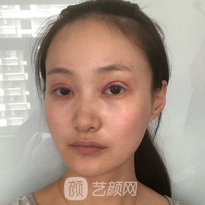 贵阳吴光宇医生双眼皮体验实例上线|附对比图