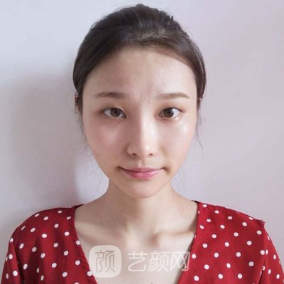  沈阳杏林房红超医生割双眼皮好吗? 70天体验实例分享