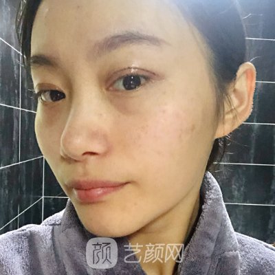 沧州华美医疗美容医院口碑好吗? 2023双眼皮整形实例一览