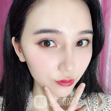 云南华美美莱李韬口碑怎么样?2023面部脂肪填充实例一览