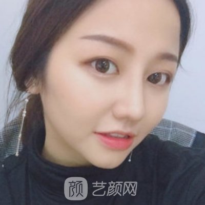 北京美莱整形技术好吗?2023亲身面部吸脂实例分享