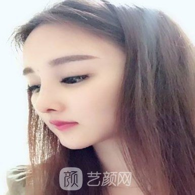 兰州皙妍丽整形医院注射除皱实例曝光附对比图