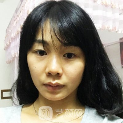 北京美莱整形医院正规吗?全新双眼皮实例公布