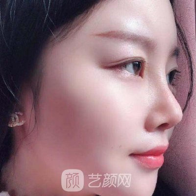 西宁润美整形医院做鼻子怎么样?医院招牌实例公开