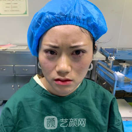 杭州格莱美张霞飞眼部修复实例曝光|全新体验实例展示