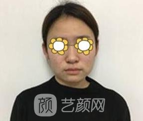 南京友谊整形医院怎么样？磨骨技术好吗？附下颌角磨骨实例