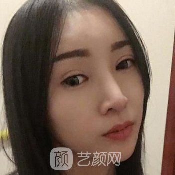 上海谈宇腾隆鼻实例，鼻子立体感很强，脸越来越精致了