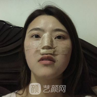 呼和浩特京美整形医院隆鼻实例出炉|80天体验实例出炉