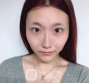 成都华美宋晓东隆鼻实例，鼻子越看越精致，闺蜜都羡慕了