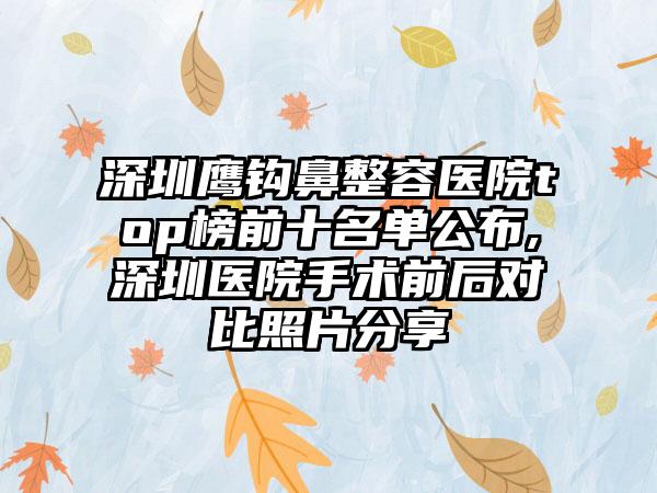 深圳鹰钩鼻整容医院top榜前十名单公布,深圳医院手术前后对比照片分享