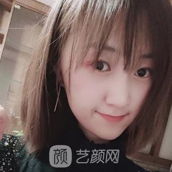 代忠洪做的帕克8度美眼实例，营造自然无痕靓丽大眼睛