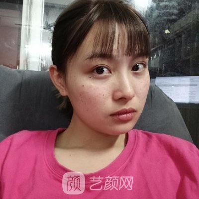 深圳恒生医院整形科光子嫩肤实例公开|成果自然无痕