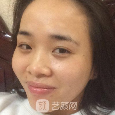 武汉恩吉娜整形医院除皱抗衰实例上线|亲测体验实例公开