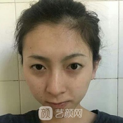 协和医院黄渭清医生做除皱抗衰实例公开|这是你想要的成果吗？