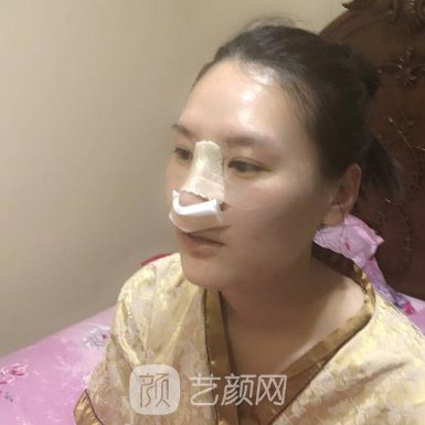 芜湖名妹整形医院隆鼻实例上线|附体验对比图