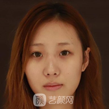 北京华韩整形美容医院隆泉实例上线附体验对比图