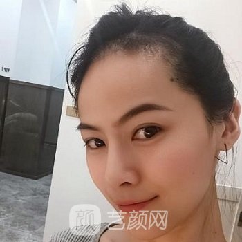 北京碧莲盛医疗美容门诊怎么样？口碑评价+植发实例对比图