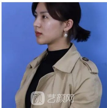 宝鸡高一生美容整形医院怎么样？隆鼻实例鉴赏+价格表