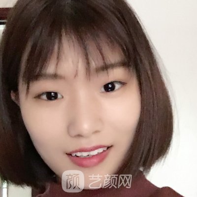 成都西婵整形医院做双眼皮自然吗？崭新体验实例一览