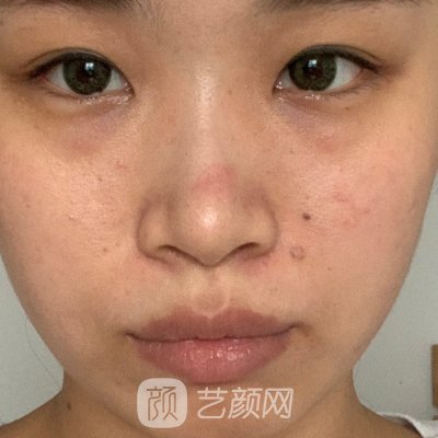 广西微美医疗美容医院面部提升实例出炉|成果自然无痕