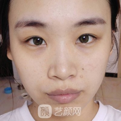 广西微美医疗美容医院面部提升实例出炉|成果自然无痕