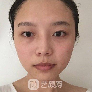 苏州美莱整形美容医院割双眼皮自然吗?80天招牌实例曝光