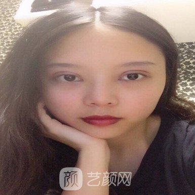 苏州美莱整形美容医院割双眼皮自然吗?80天招牌实例曝光