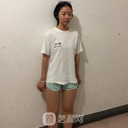 深圳宝丽整形美容医院吸脂实例公布|成果自然美观