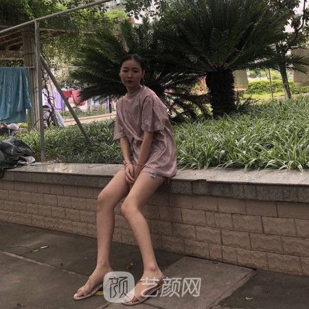 深圳宝丽整形美容医院吸脂实例公布|成果自然美观