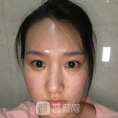 杭州格莱美整形美容医院隆鼻实例展示|成果自然无痕