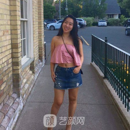 义乌阳光整形美容医院吸脂实例展示|内附对比图