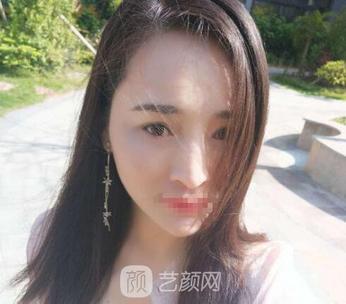 沈阳杏林整形双眼皮失败修复实例，再也不用花两次钱遭两次罪