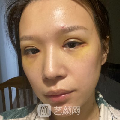 上海伊莱美朱迪医生双眼皮修复靠谱吗？医生招牌实例曝光