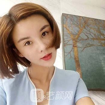 长沙华韩华美整形怎么样？真人脂肪填充面部实例对比图