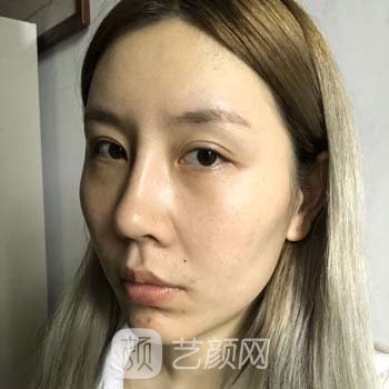 无锡二院热玛吉一次多少钱？技术怎么样？热玛吉美容实例