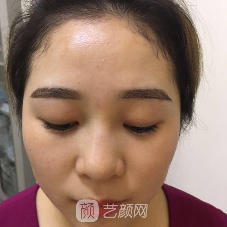 北京博美整形医院割双眼皮好吗?80天亲测实例展示