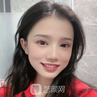 惠州瑞悦美医疗美容医院怎么样?全新拉皮除皱实例分享