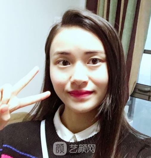 郑广森正颌手术实例，随便收拾一下就是个小美女