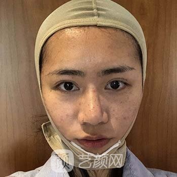 郑大二附院整形科承包了吗？技术如何？医生介绍+面部吸脂实例